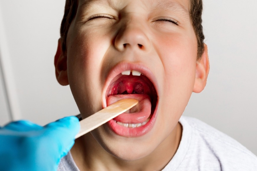 Treatment for mouth breathing in children Treatment for snoring in children